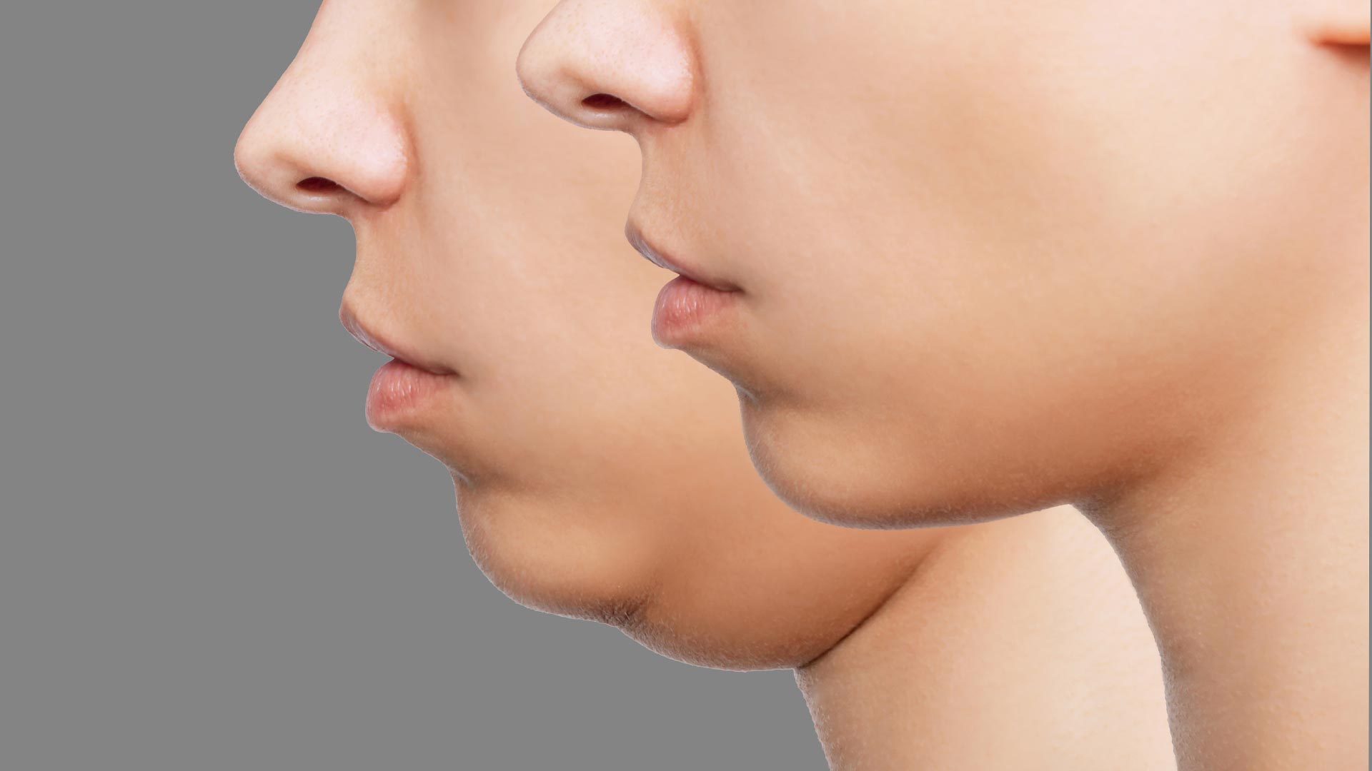 علاج الذقن المزدوج ونحت خط الفك — ضمن خدمات مركز الوزن المثالي أبو ظبى بدون جراحة